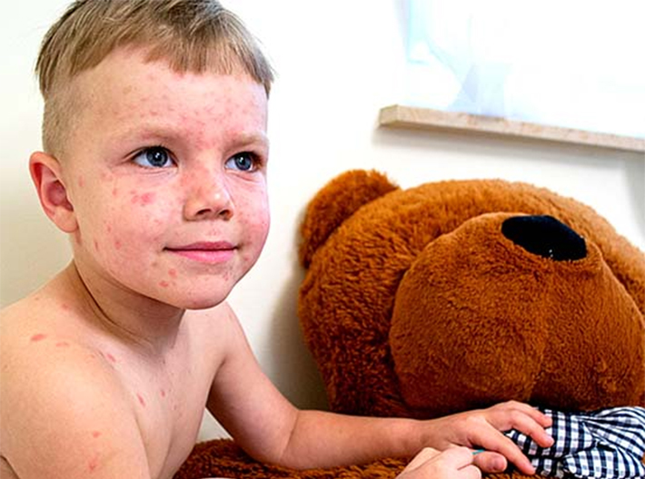 Chickenpox: managing the symptoms