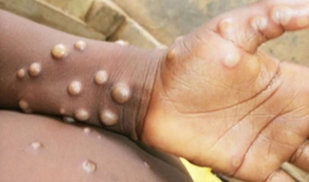 Screening protocol for Mpox at Bengaluru airport soon